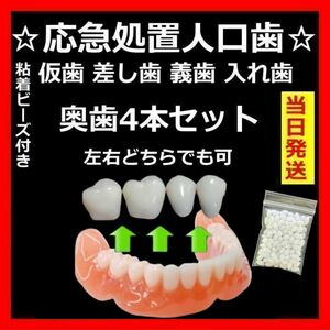 仮歯　差し歯　入れ歯　奥歯4本　フィッティングビーズ付き