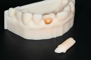 歯科　歯科技工　支台歯が抜ける3Dプリントモデルデータの作成法の解説書　 IOS Dental CAD 3Dプリントモデル　Meshmixer