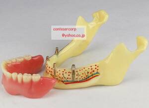 研究用歯列模型 下顎 インプラントオーバーデンチャー 総義歯 入れ歯