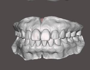 歯科　歯科技工　テンポラリーデンチャー ベースライブラリー　10組　デジタルデンタルデザインアイテム　stlデータ