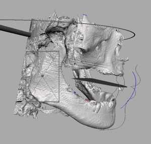 歯科　歯科技工　3D骨データ上の仮想咬合平面設定方法　mp4動画　テンプレート　セファロ