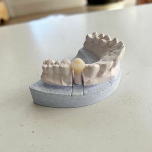 硬質レジン冠 サンプル　歯科模型